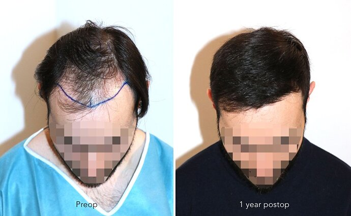 Case performed by Dr. Feriduni – 3744 FU in 1 procedure photo