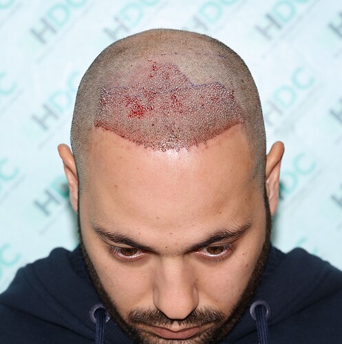 Result of 2 FUE Sessions For Total 5700 grafts - Front and Crown – HDC Hair Clinic photo