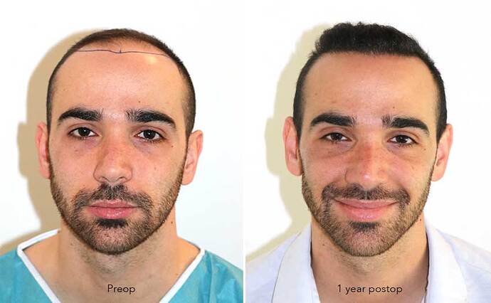 Case performed by Dr. Feriduni – 3505 FU in 1 procedure photo