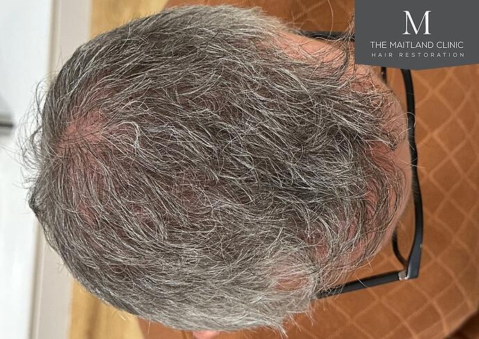 Dr Ball - The Maitland Clinic 2448 Grafts By FUT photo