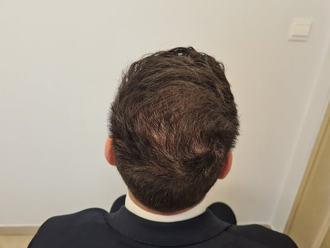 Crown Result of 3rd FUE for 2410 Grafts – HDC Hair Clinic photo