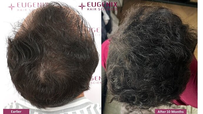 Dr. Somesh| Eugenix Hair Sciences Clinic | NW 3 | 3007 Grafts | 10 Months Post-op photo