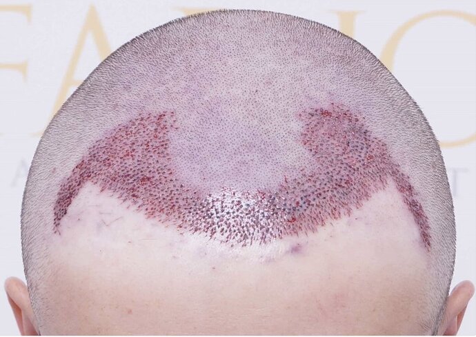 Dr Bessam Farjo FUE 1720 grafts to frontal recessions photo