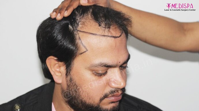 Dr. Suneet Soni - 4937 Grafts, Combine FUT + FUE Technique, NW : IV-V photo