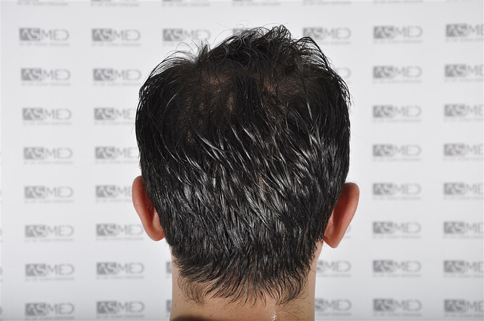 ASMED by Dilek Cakir - 4033 graft - Combo Micro & Manual FUE photo