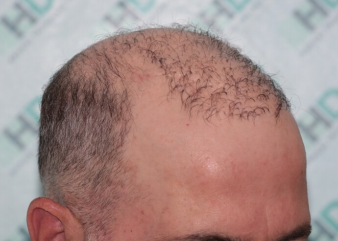 Major Repair of Mini Grafts - Result: 4160 Grafts – HDC Hair Clinic photo