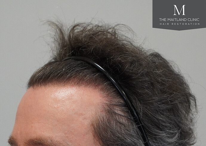 Before and after results: 1694 grafts by FUE at The Maitland Clinic (Dr Edward Maitland Ball) photo