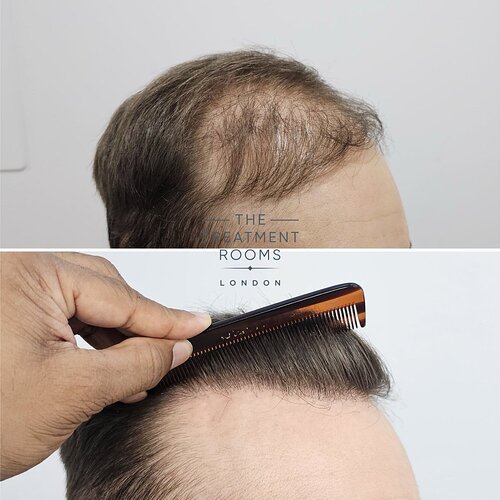 Hair Transplant Repair- 1733 Grafts photo