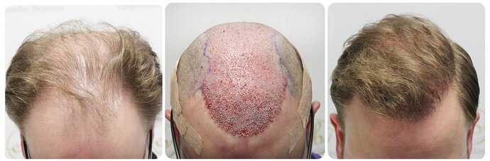 Dr Bonaros, Glasgow, UK / 4081 FUE grafts / 0-12 Months photo