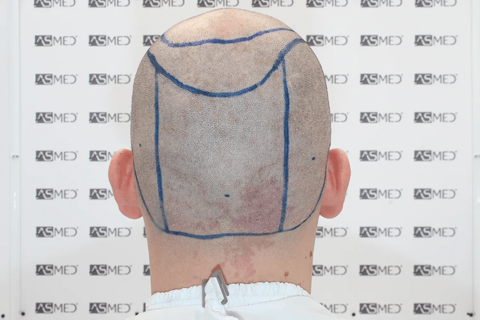 ASMED, Istanbul: 5,071 Manual FUE Grafts 0/12 Months photo