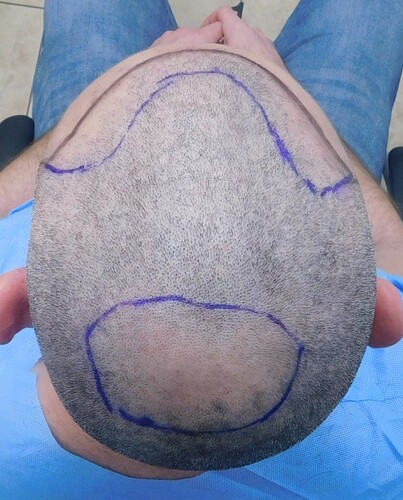 Result of Class 3V Patient – 3530 Grafts – HDC Hair clinic – Dr Maras photo