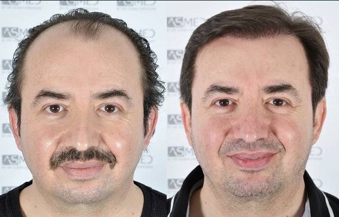 ASMED CLINIC - DR.KORAY - 5060 GRAFTS FUE photo