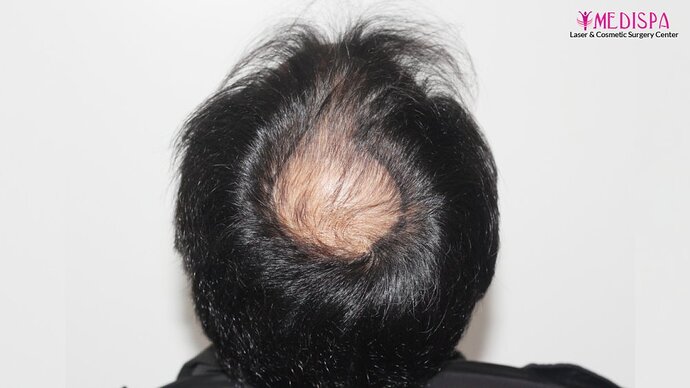 Dr. Suneet Soni - 4937 Grafts, Combine FUT + FUE Technique, NW : IV-V photo