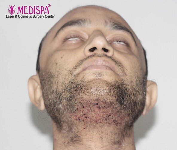 Dr. Suneet Soni - 5000 Grafts, Combine FUT + FUE + Beard, NW-VI photo