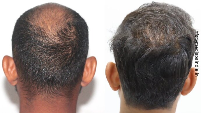 Dr. Suneet Soni - 5294 Grafts, Combine FUT + FUE + Beard Technique, NW- VI, 2 Years Result photo