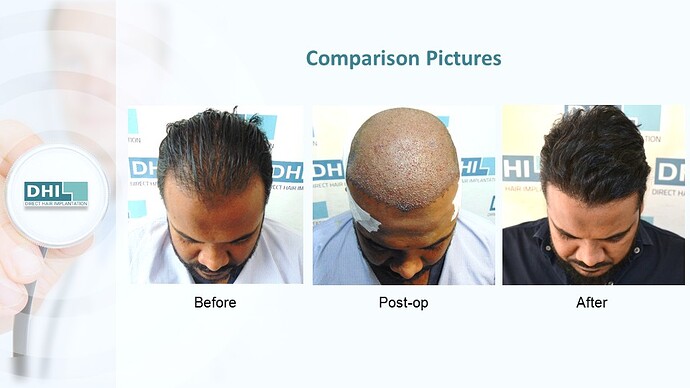 DHI India™ | NW 3 | 4,821 Grafts | 1 year DHI Hair Transplant Results photo