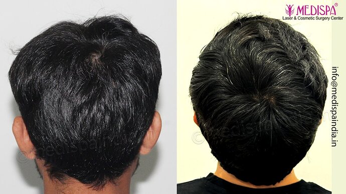 Dr. Suneet Soni - 3029 FUE Grafts, FUE Method (Trivellini System), NW - III photo