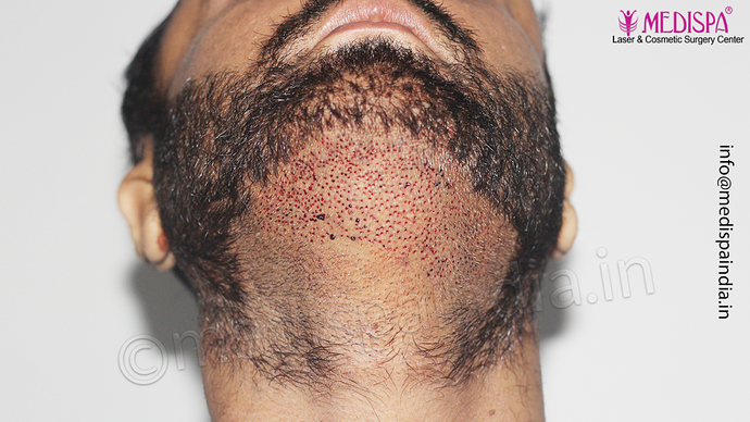 Dr. Suneet Soni - 5334 Grafts, Combine FUT + FUE + BHT (Beard) Technique, NW- V photo