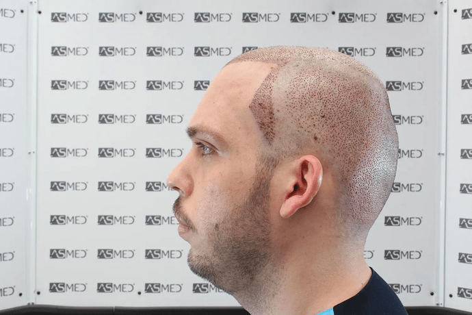ASMED, Istanbul: 5,071 Manual FUE Grafts 0/12 Months photo
