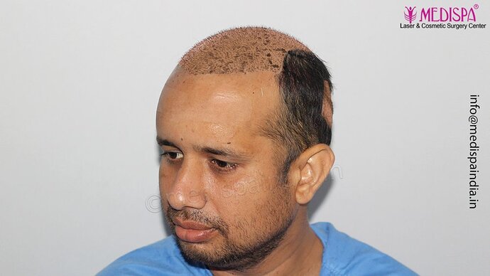 Dr. Suneet Soni - 4500 Grafts, Combine FUT + FUE Technique, NW-III photo