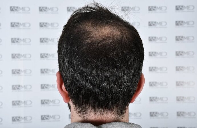 ASMED CLINIC CASE - DR.KORAY 5000 GRAFTS FUE photo