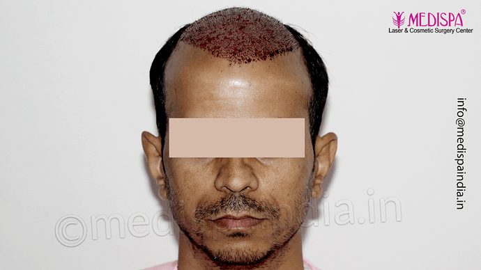 Dr. Suneet Soni - 4533 Grafts, Combine FUT + FUE Technique , NW-IV/V photo