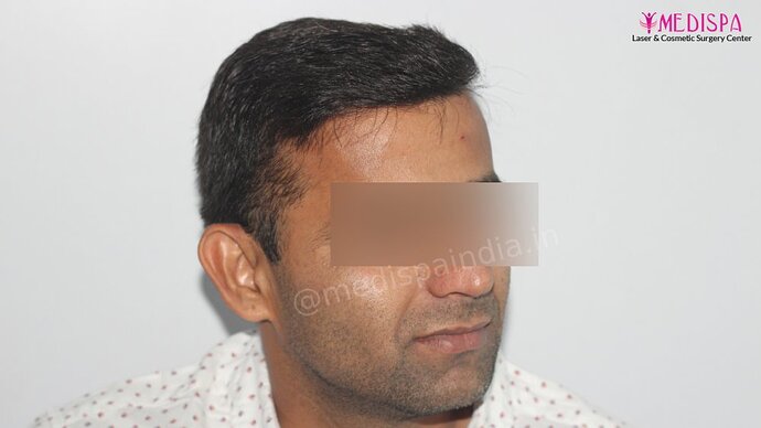Dr. Suneet Soni - 4025 Grafts | 12-Month Result | Combination FUT + FUE photo
