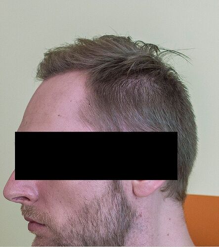 Dr. Bisanga, 2382 FUE. 0-12 Months. BHR Clinic photo