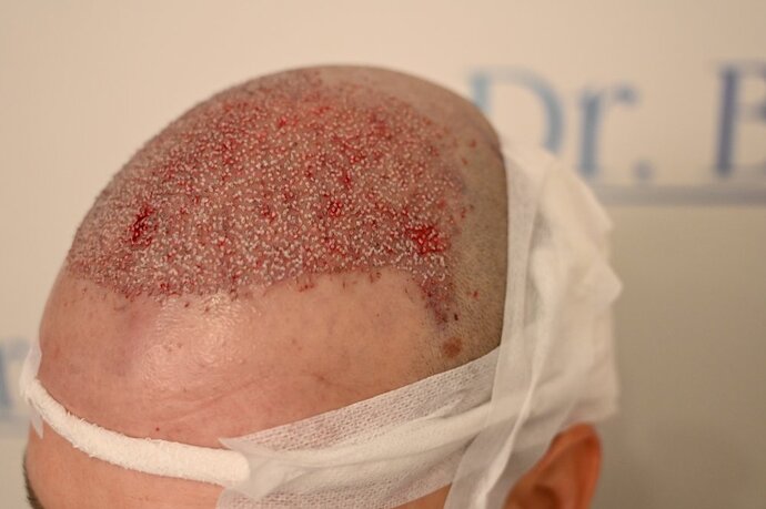 Ozlem Bicer MD-Hair Transplant-3980 Grafts FUE by micro-motor, 12. months result photo