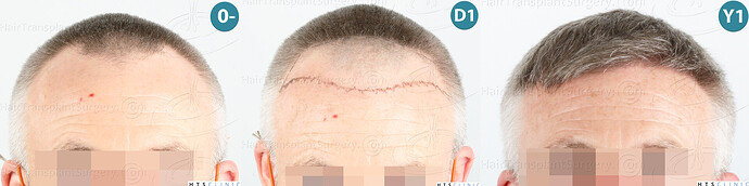 Dr. Jean Devroye, HTS Clinic / 2052 FUE / Hairline restoration photo