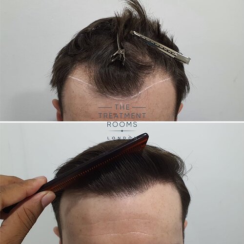 Small hairline 1014 grafts before and after photo