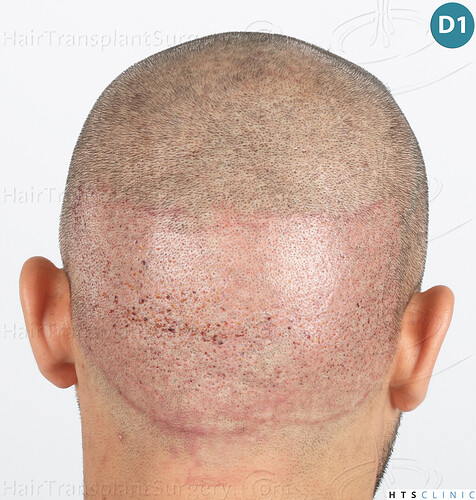 Dr Devroye + Dr Montesanti + Dr Jenard, HTS Clinic / 2018 FUE / Hairline & frontal area photo