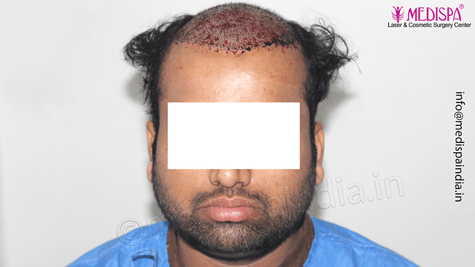 Dr. Suneet Soni - 5467 Grafts, Combine FUT + FUE + Beard Technique, NW- V, 3 Years Result photo