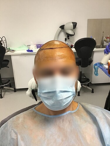 Dr.Bisanga, BHR Clinic Brussels 3251 FUE 0 - 8 Months photo