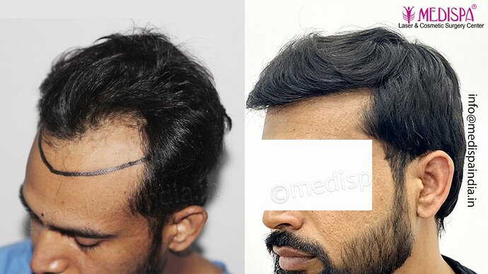 Dr. Suneet Soni - 3029 FUE Grafts, FUE Method (Trivellini System), NW - III photo