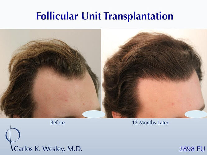 #BAM Hairline and Temples + a Light Crown Coverage (2898 FUT grafts): Carlos K. Wesley, M.D. (NYC & LA) photo