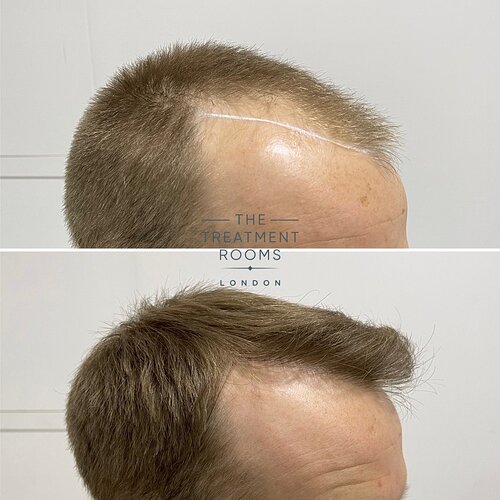 1756 grafts result- The Treatment Rooms London photo