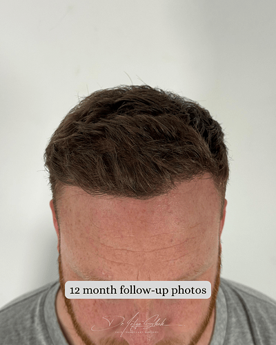 Dr Shah (London, UK) 3114 FUE grafts (0-12 months) photo
