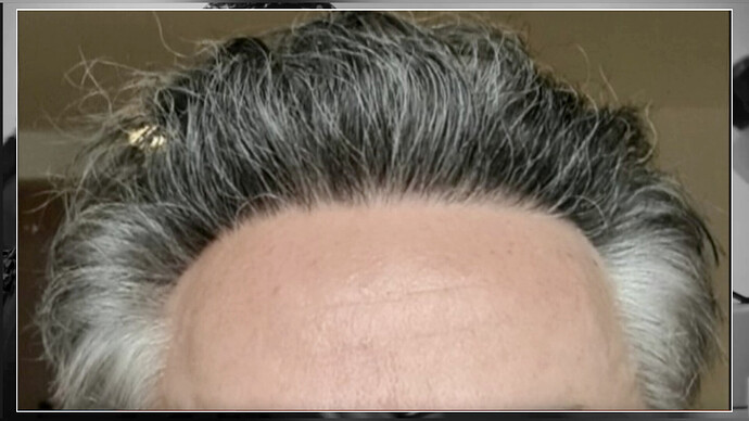 Dr.Bisanga, BHR CLINIC, 2553 FUE 0 - 7.5 MONTHS photo