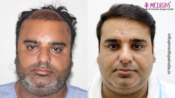 Dr. Suneet Soni - 4500 Grafts, 3 Year Result, NW-IV, Combine FUT + FUE Technique photo