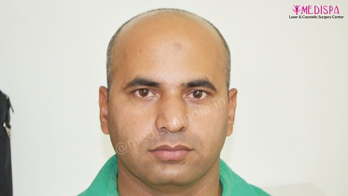 11600 Grafts in 3 FUT Sittings by Dr Suneet Soni photo
