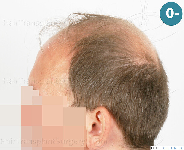 Dr. Jean Devroye, HTS Clinic / 2238 FUE / NW VI, 1st session photo