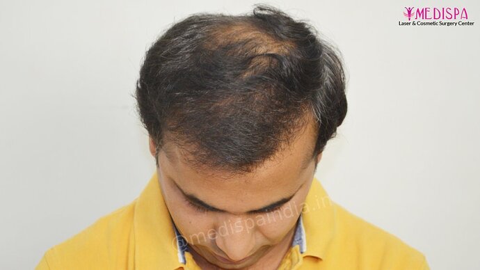 11600 Grafts in 3 FUT Sittings by Dr Suneet Soni photo