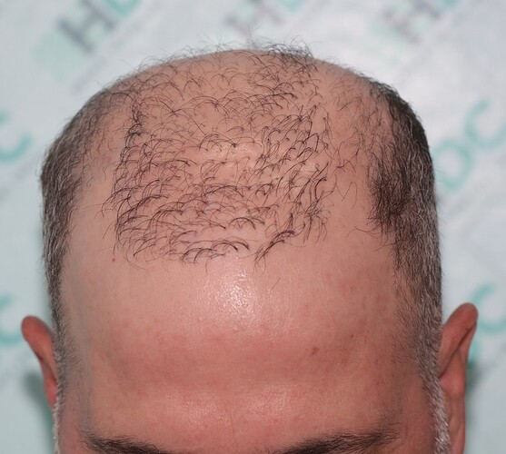 Major Repair of Mini Grafts - Result: 4160 Grafts – HDC Hair Clinic photo