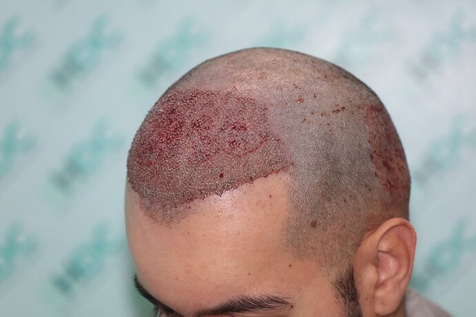 FUE Hair Transplant Result for 3100 Grafts - NW3 – 8 Months After – HDC Hair Clinic photo