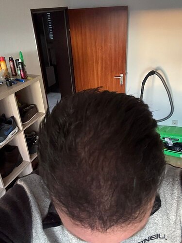 Ozlem Bicer MD-Hair Transplant-2910 Grafts FUE by micro-motor, 7. months result photo