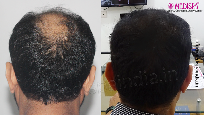 Dr. Suneet Soni - 5334 Grafts, Combine FUT + FUE + BHT (Beard) Technique, NW- V photo