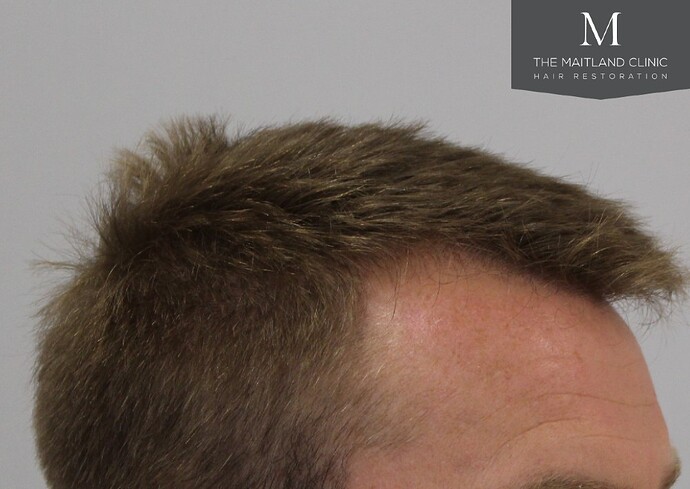 Dr Ball - The Maitland Clinic 1204 Grafts By FUE photo