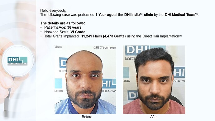 DHI India™ | NW 6 | 4,473 Grafts | 1-Year Hair Transplant Result photo