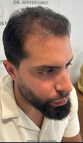 Dr Fares Seffen (Tunis, Tunisia) 3760 FUE results (Diffuse NW 4) Day 0 --> 10 Months after photo